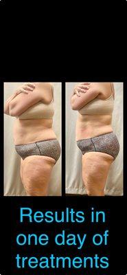 These results were achieved in 1 day . We did 2 cool slims and 2 cavitation / RF treatments .