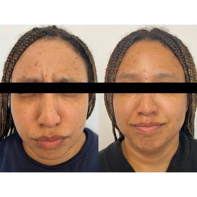 Before and after Botox brand Jeuveau full face and half syringe undereye filler.