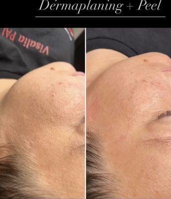 Dermalplaning + peel treatment by Cynthia S