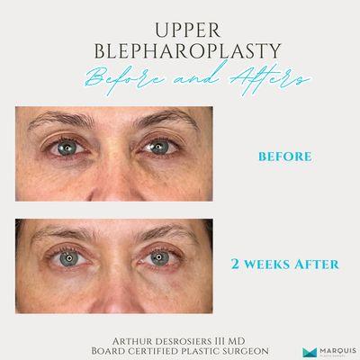 Upper Blepharoplasty