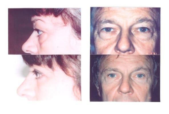 Before & After Upper & Lower Eyelid surgery