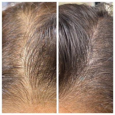 FEMALE Scalp Micro-Pigmentation 
1st of 3 session for scalp coverage and appearance of more hair for thinning and/or balding