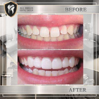 life changing transformation with veneers