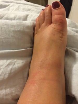 A good ol' swollen PsA foot tonight. Skin even breaking open at toes from swelling.