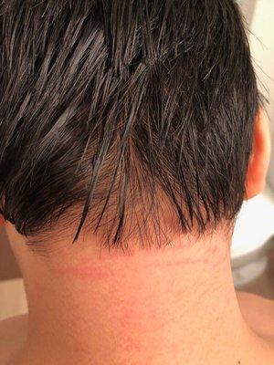 Full stretch of red inflammed skin caused by a razor used in haircut of my son of an unskilled and harsh woman named Chau!