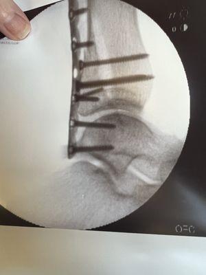 Screws and rods after surgery