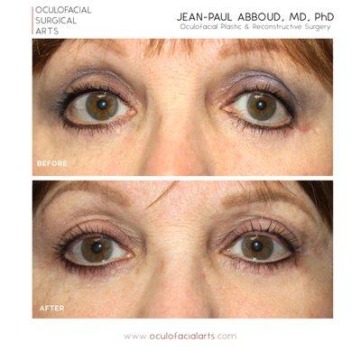 Lower Eyelid Revision Surgery and Retraction Repair via Midface Lift and Canthoplasty