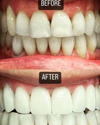 Another same day smile at Laguna Dental