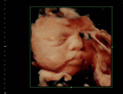 Look at those cheeks! A chunky baby as seen in a SonoSmile 4D sonogram using HDlive.