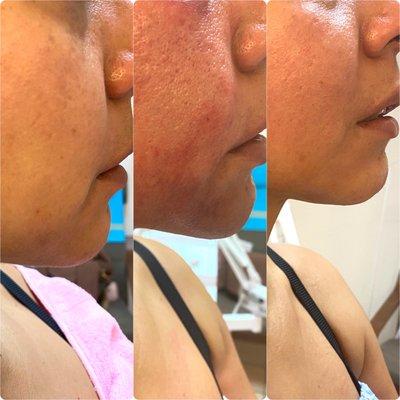 Our new Face and neck PDRN microneedling facials visibly lift and tighten the face without any invasive treatments