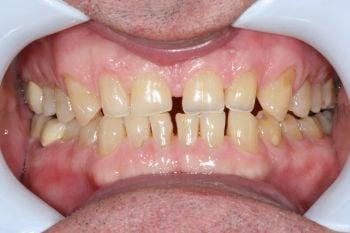 Porcelain Veneers
(before)