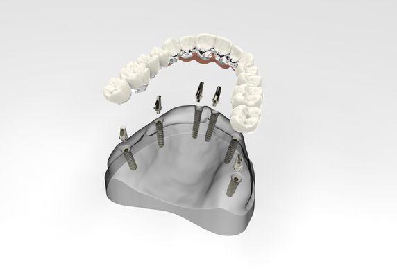 ALL-On-6 Dental Implants