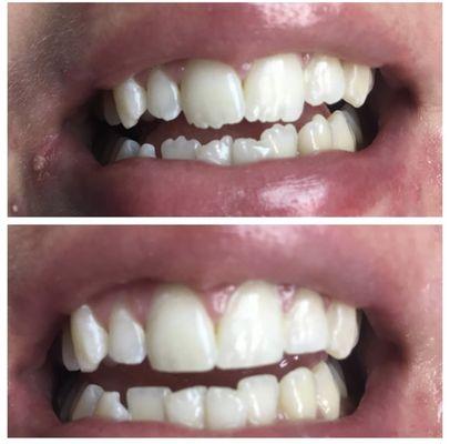 My patient originally wanted braces , I trimmed the incisal edges of her teeth and saved her over 5000.00 and 1 year of treatment