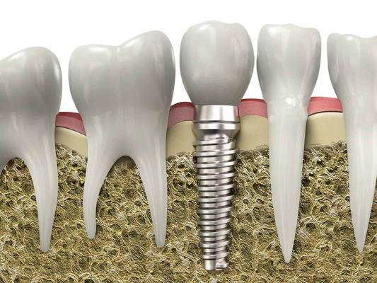 Dental Implant