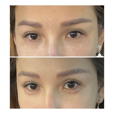 Using dermal filler to enlarge the eyes and lift the brows