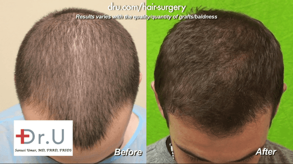 A happy and satisfied client! Failed Strip Surgery Hairline Transplant Repaired by Dr.U - 1500 Grafts Before & After Results V4