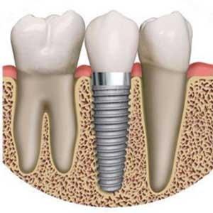 Dental implants for missing teeth