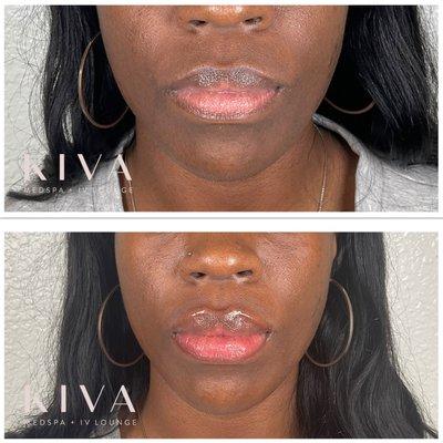 Lip filler before & after by Crystal