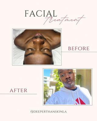 after signature facial with a sensitive-skin-safe approach