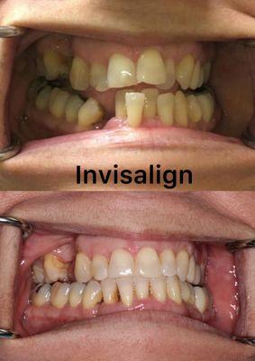 Invislign by Dr. H at OC Perfevt Smile cosmetic dentistry in Orange County, CA.  $500 Off Dental Implants, Call (949) 810-0121