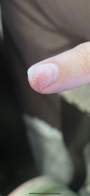 This is her nail after she ripped off the acrylic before she painted the gel on.