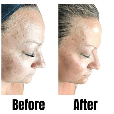 Anti-aging treatment on the face.