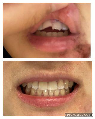 Before and after. Awesome patient who had an accident with damage to her front teeth. Things look great again and she is healing well!