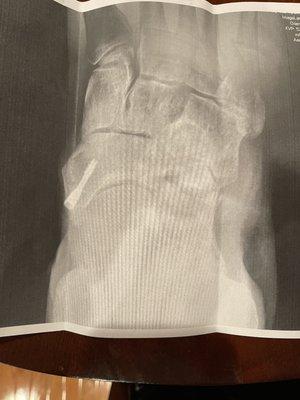 X-ray to check the screw in the navicular (2.21.23)