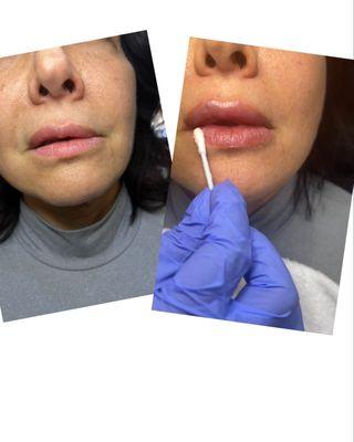 Before and after lip filler treatment! Asymmetry is no problem for Nurse Jackie! Happy client with gorgeous lips!