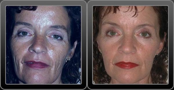 Facelift Before & After