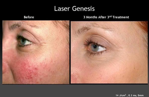 Laser Genesis™ helps to reduce the appearance of acne scars, minimize pores and even out skin tone.