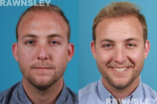 Hair Transplant Before & After | Rawnsley Hair Restoration