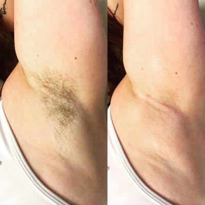 Underarms wax ,get summer ready !!!