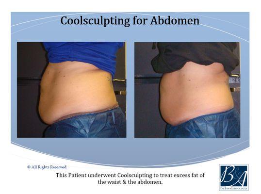 CoolSculpting for Abdomen