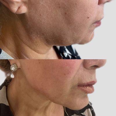 Jawline contouring with dermal filler