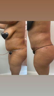 This client is still healing but you can see her results coming thru