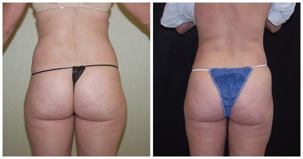 Liposuction Before & After