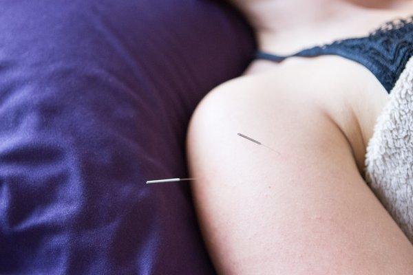 Shoulder Acupuncture Treatment