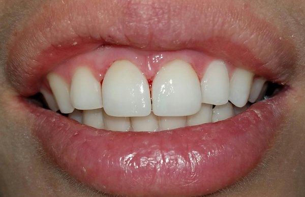 After picture of anterior veneers, which were done in the same day with cerec machine