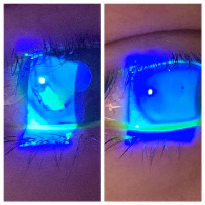 Severe cornea abrasion (bright lit area in left picture) and same eye 3 days after treatment.  100% healed!