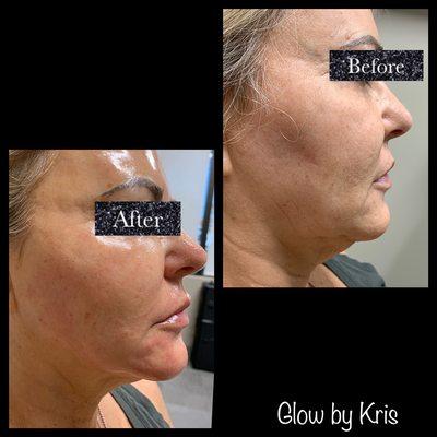 Natural Full Face Rejuvenation!