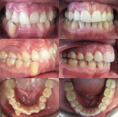 Invisalign with Four Canines Extracted