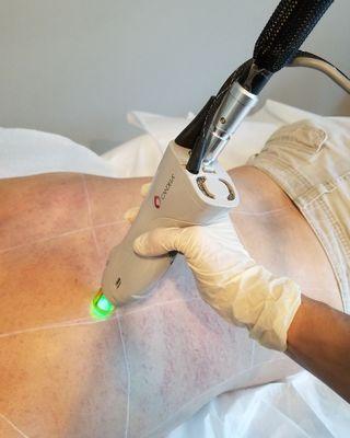 Men's laser hair removal