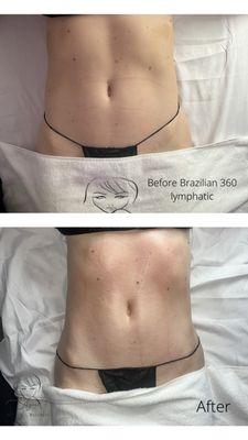 Before and after 360 lymphatic