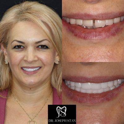 Dental Implants at Smile Boutique