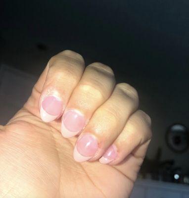 Bleeding cuticles, uneven nail shape, etc.