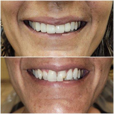 Beautiful smile makeover of a patient with broken front teeth! Done in just 2 visits