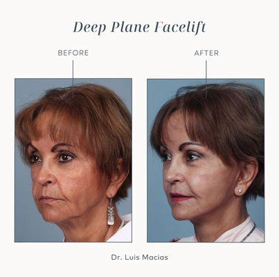 Deep Plane Facelift by: Dr.Luis Macias