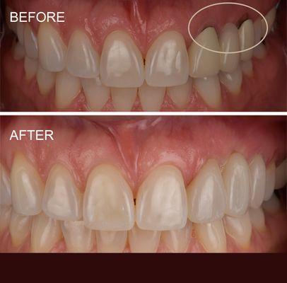 Dark lines around crowns corrected with all porcelain / ceramic crowns.