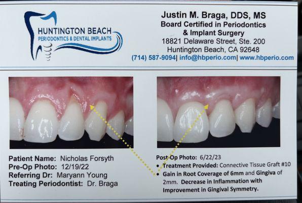 Before and After of Gum Graft done at Huntington Beach Periodontics & Dental Implants by Dr. Braga